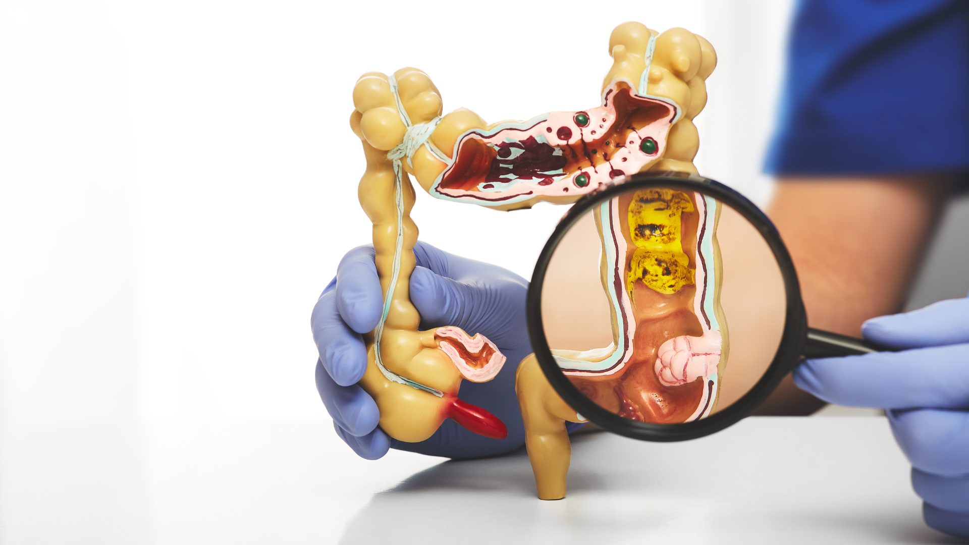Enfermedades del colon - Dr. José Carmona
