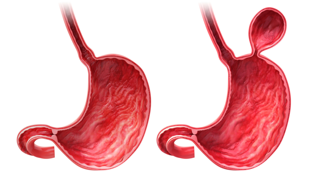 Cirugía de hernia - tipos de hernias - Dr. José Carmona