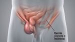 Hernias_Cirugía Hernoplastia_Dr. Carmona