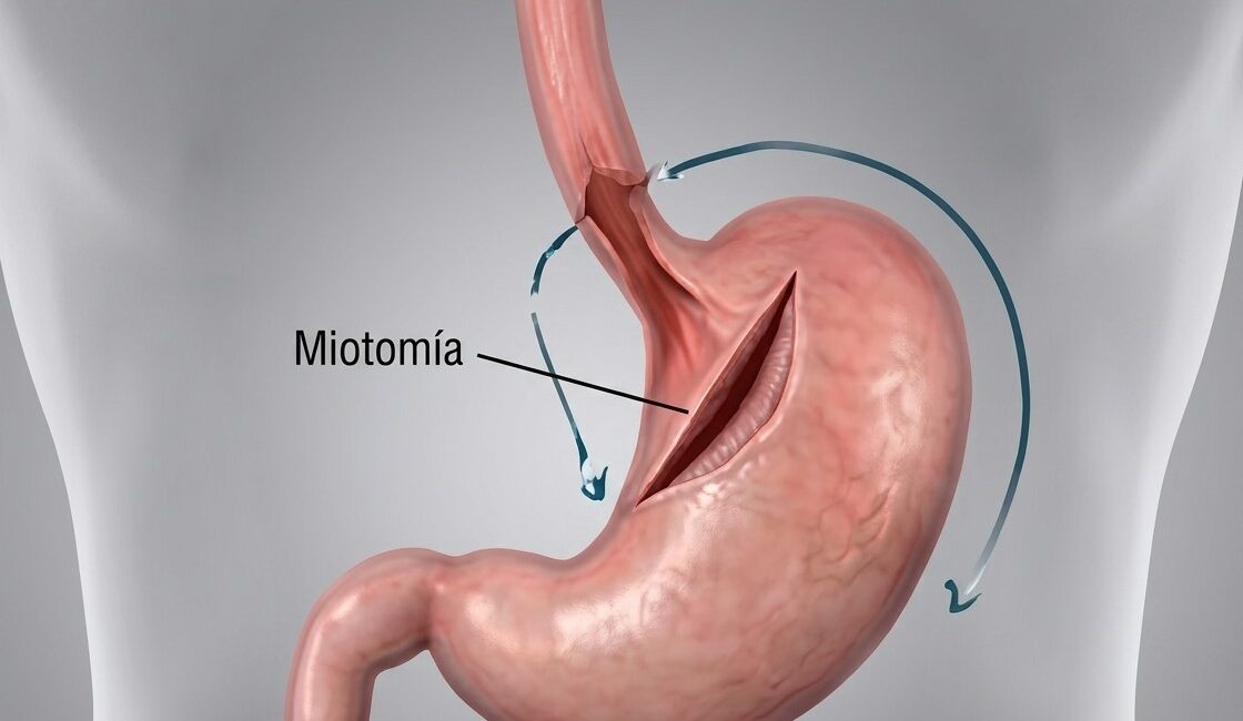 Miotomía de Heller_Cirugía Acalasia_Dr. Carmona