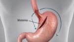Miotomía de Heller_Cirugía Acalasia_Dr. Carmona