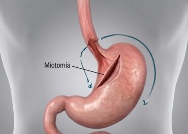 Miotomía de Heller o Cirugía Acalasia | Cirujano Dr. José Carmona
