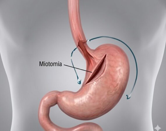 Miotomía de Heller o Cirugía Acalasia | Cirujano Dr. José Carmona