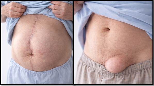 Hernias y eventraciones - Dr. José Carmona