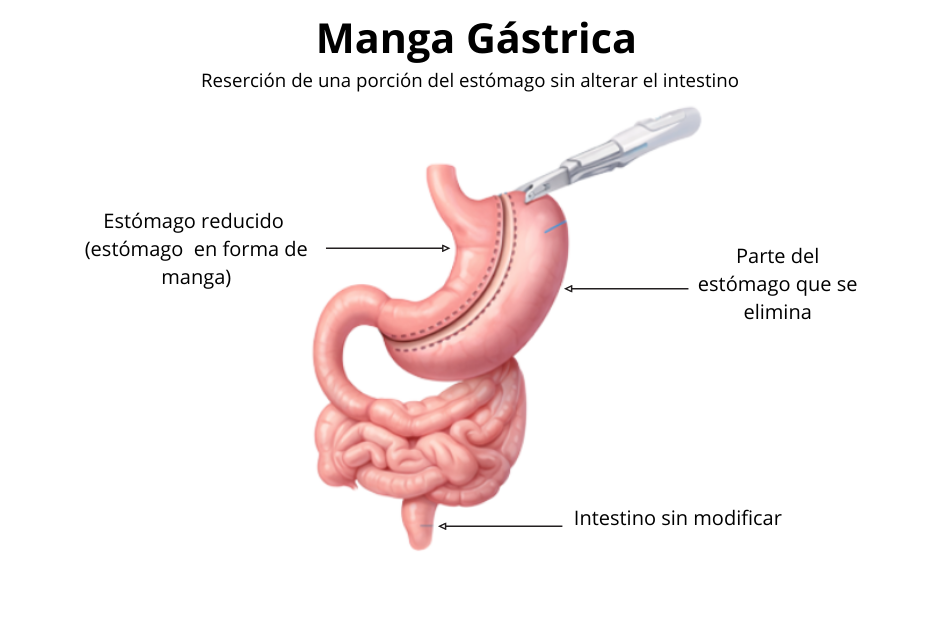 Infografía Manga Gástrica Dr. José Carmona