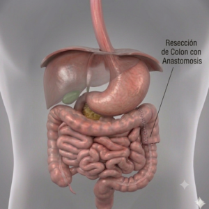 Cáncer de colon procedimiento Dr. Carmona