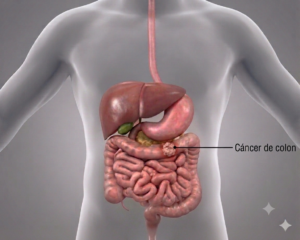Cáncer de colon tratamiento y diagnóstico Dr. Jose Carmona