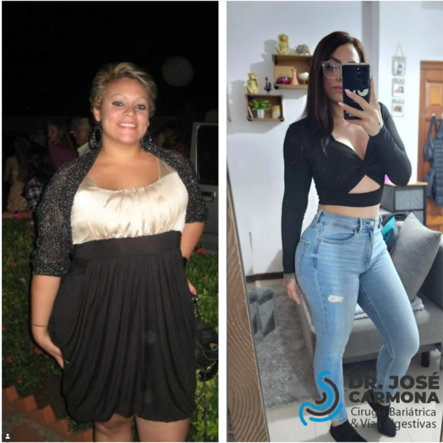 Maryeling Soler Paciente bariatrico Dr. Carmona Maryeling Soler Paciente bariatrico Dr. Carmona